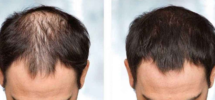 Understanding male hair loss- Causes and Solutions