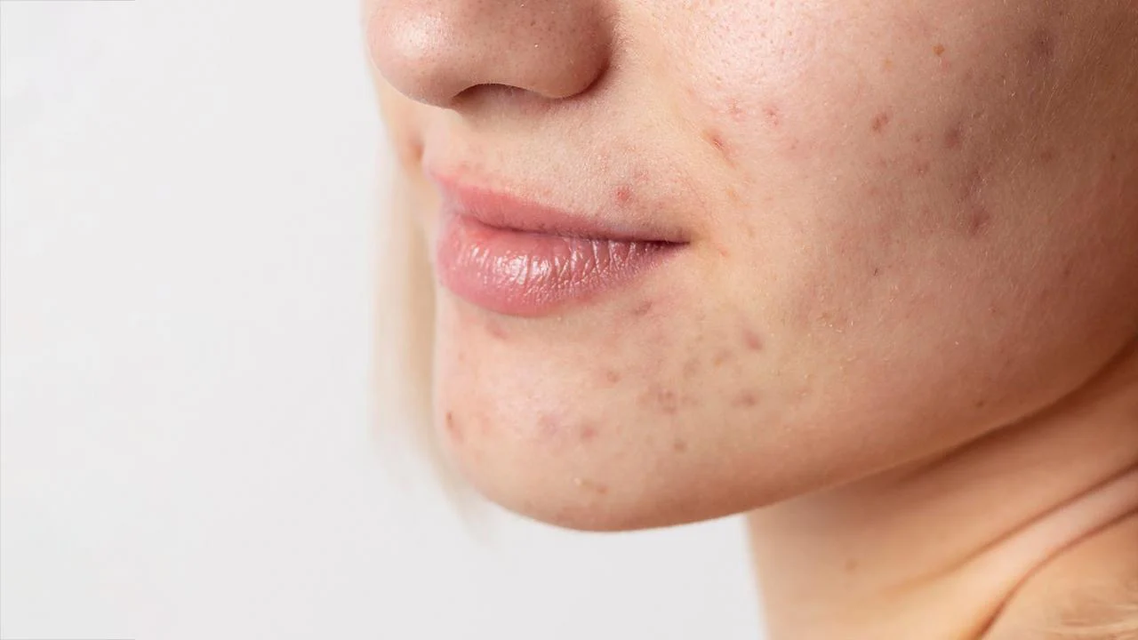 Beyond the Surface: Understanding the Root Causes of Acne