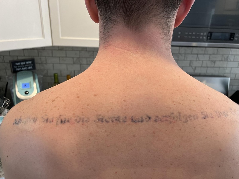 Neatcell Tattoo Removal Reviews: What You Need to Know Before Buying