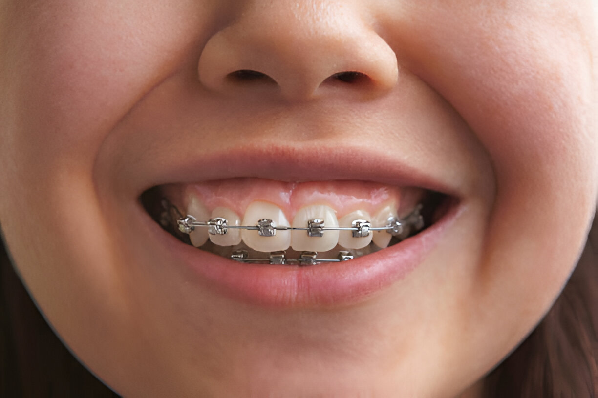 Signs You Need Metal Braces and Not Clear Aligners