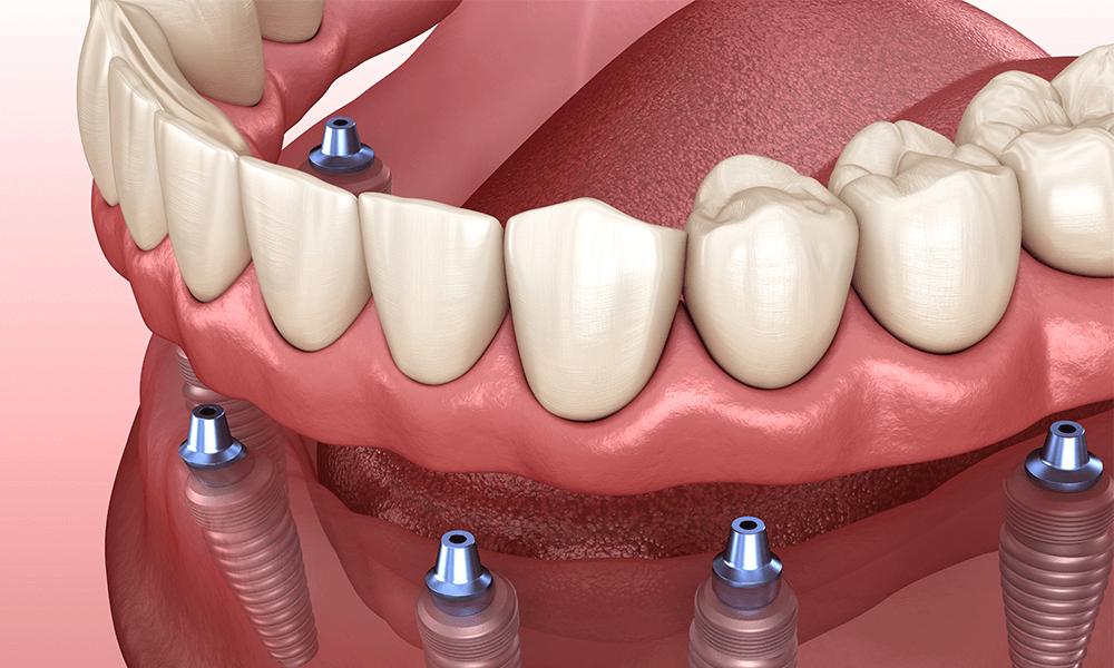 Implant-Retained Dentures